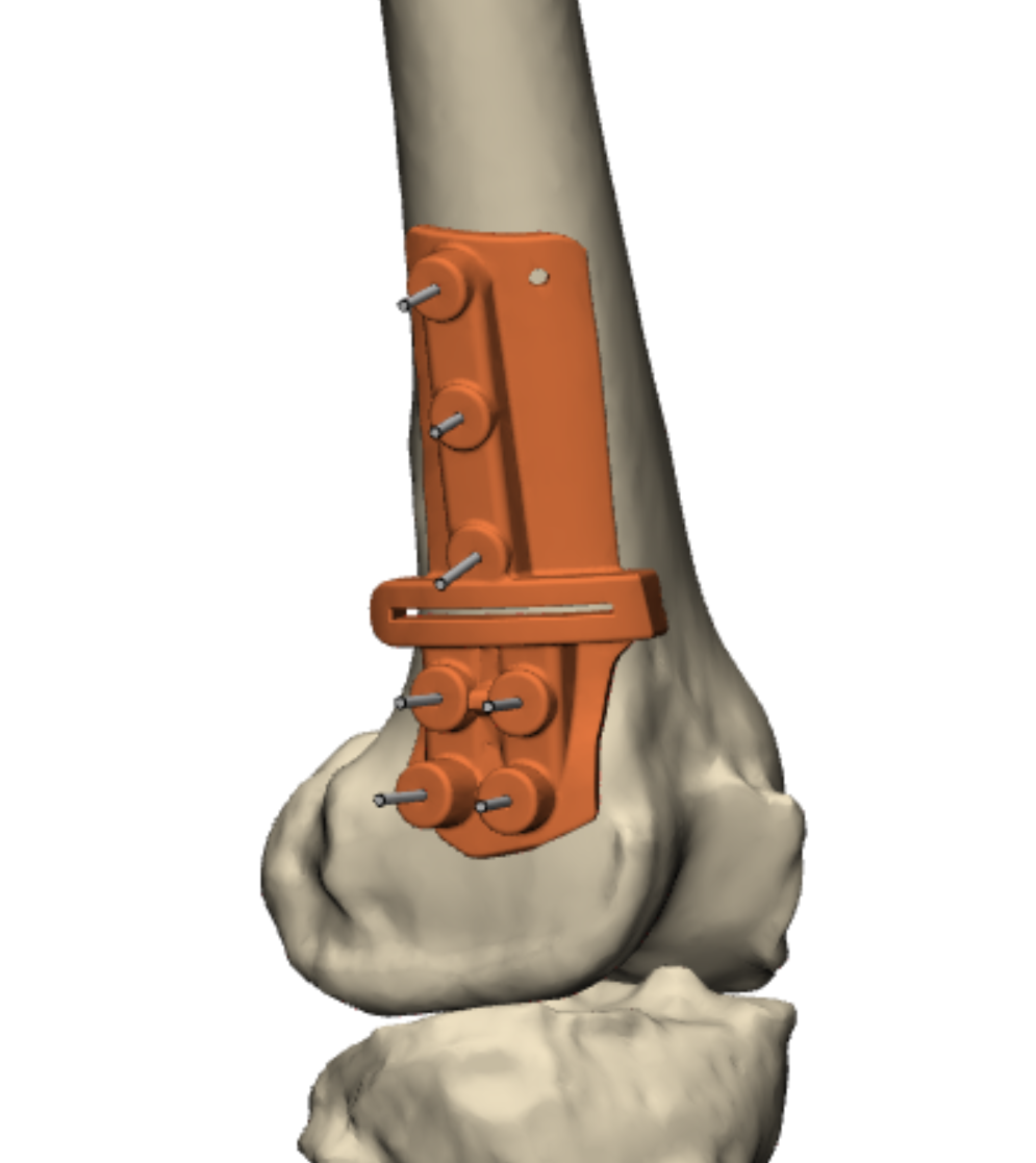 Limb Deformity Correction - Synergy3DMed